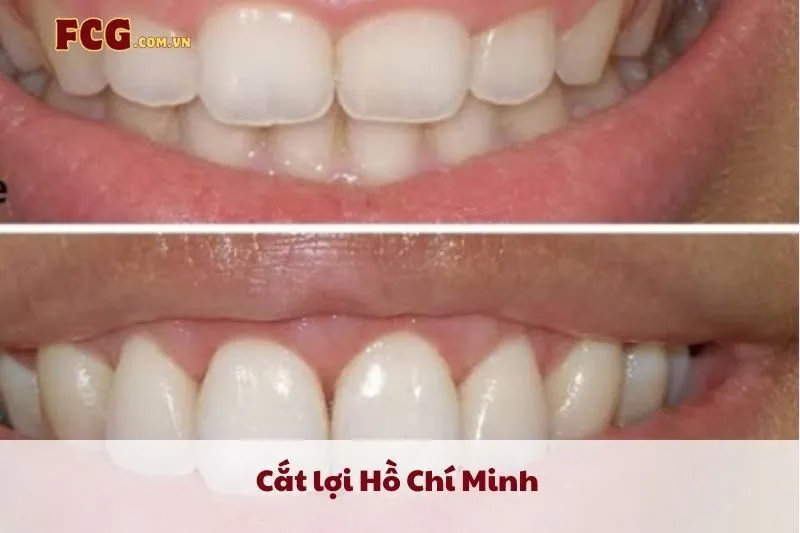 Cắt lợi Hồ Chí Minh 2025: Top 10 địa chỉ nha khoa thẩm mỹ uy tín nhất